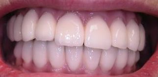 implantátum