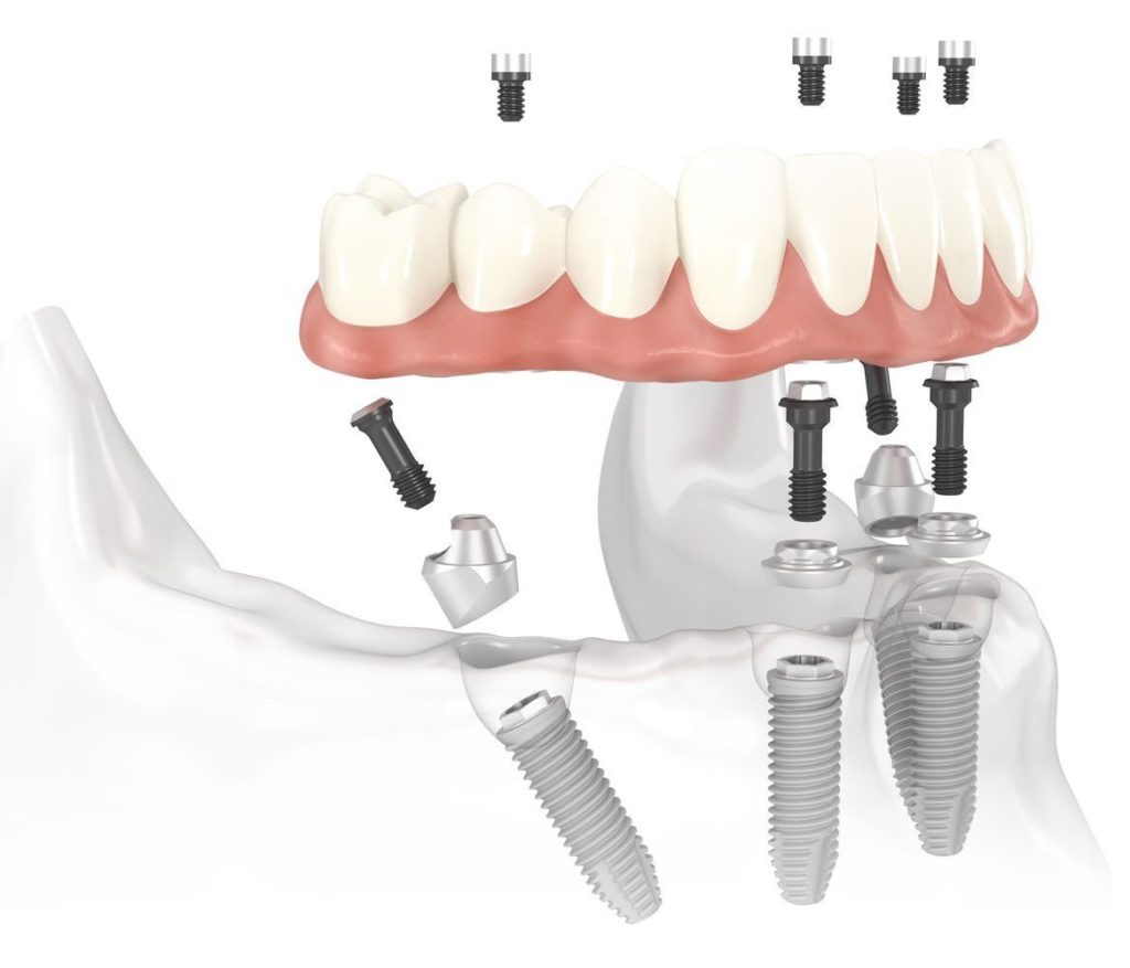 implantátum