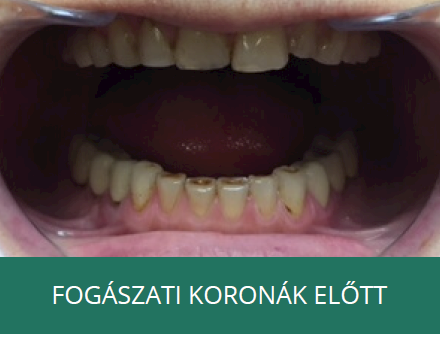 fogászati korona