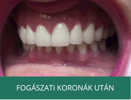 fogászati korona